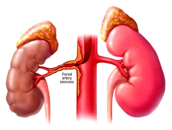 动脉堵塞所导致: 肾:肾动脉狭窄,是当肾动脉粥样硬化阻碍至肾脏的血流